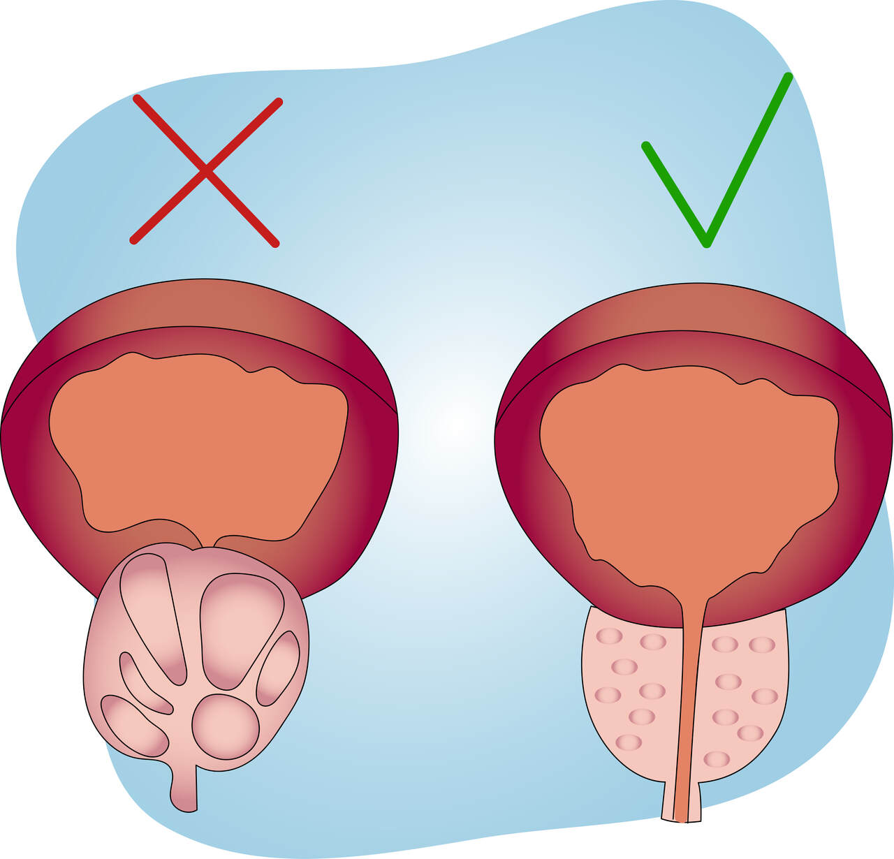 Tipos de cirurgias para tratamento da hiperplasia de próstata