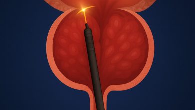 Conheça a técnica mais moderna para tratar o aumento da próstata com cirurgia a laser