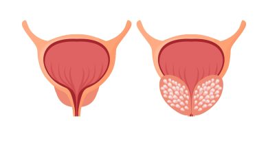 HPB (Hiperplasia Prostática Benigna) não vira câncer