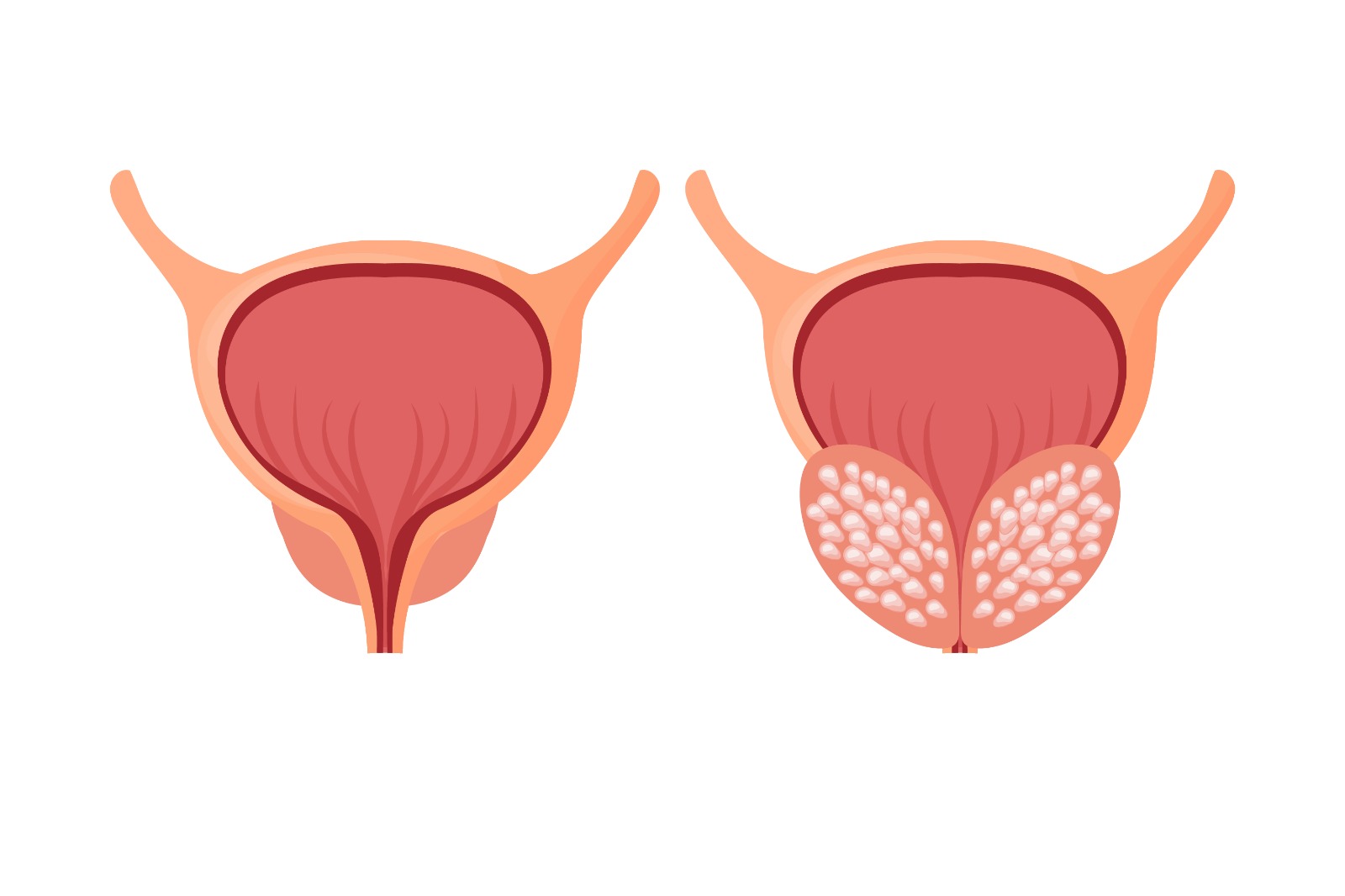 HPB (Hiperplasia Prostática Benigna) não vira câncer