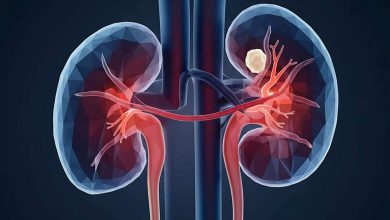 Quando a pedra no rim não sai sozinha. A cirurgia é o caminho